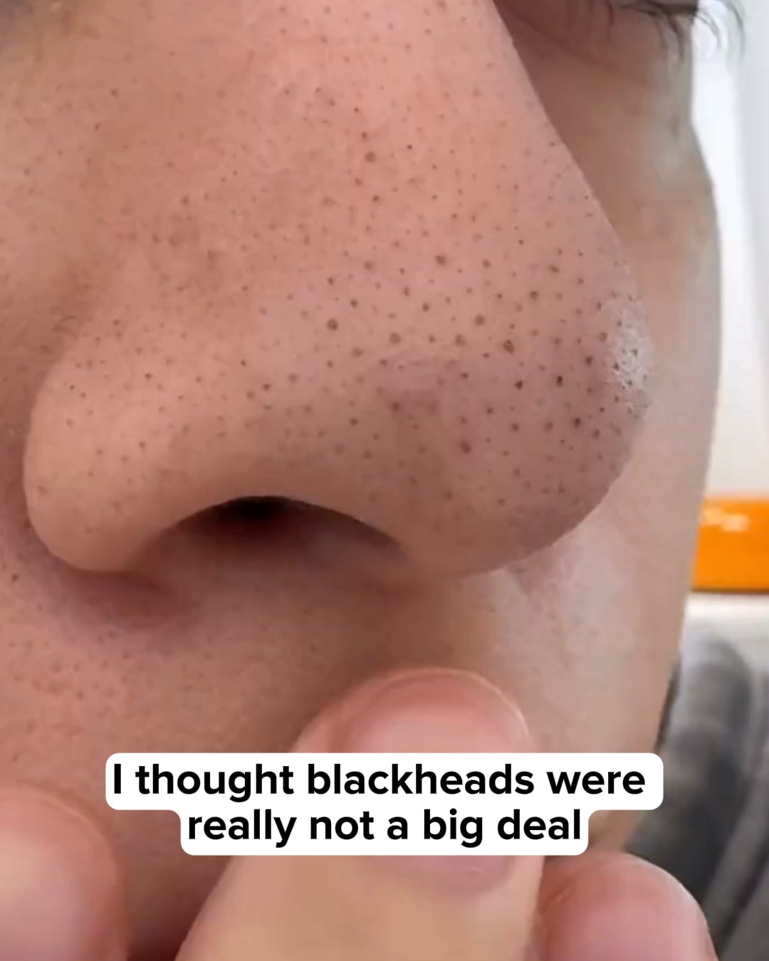 Get rid of spots now!