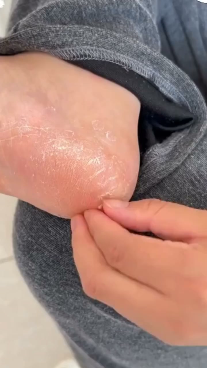Dry Feet? Try This Easy Moisture Stick!