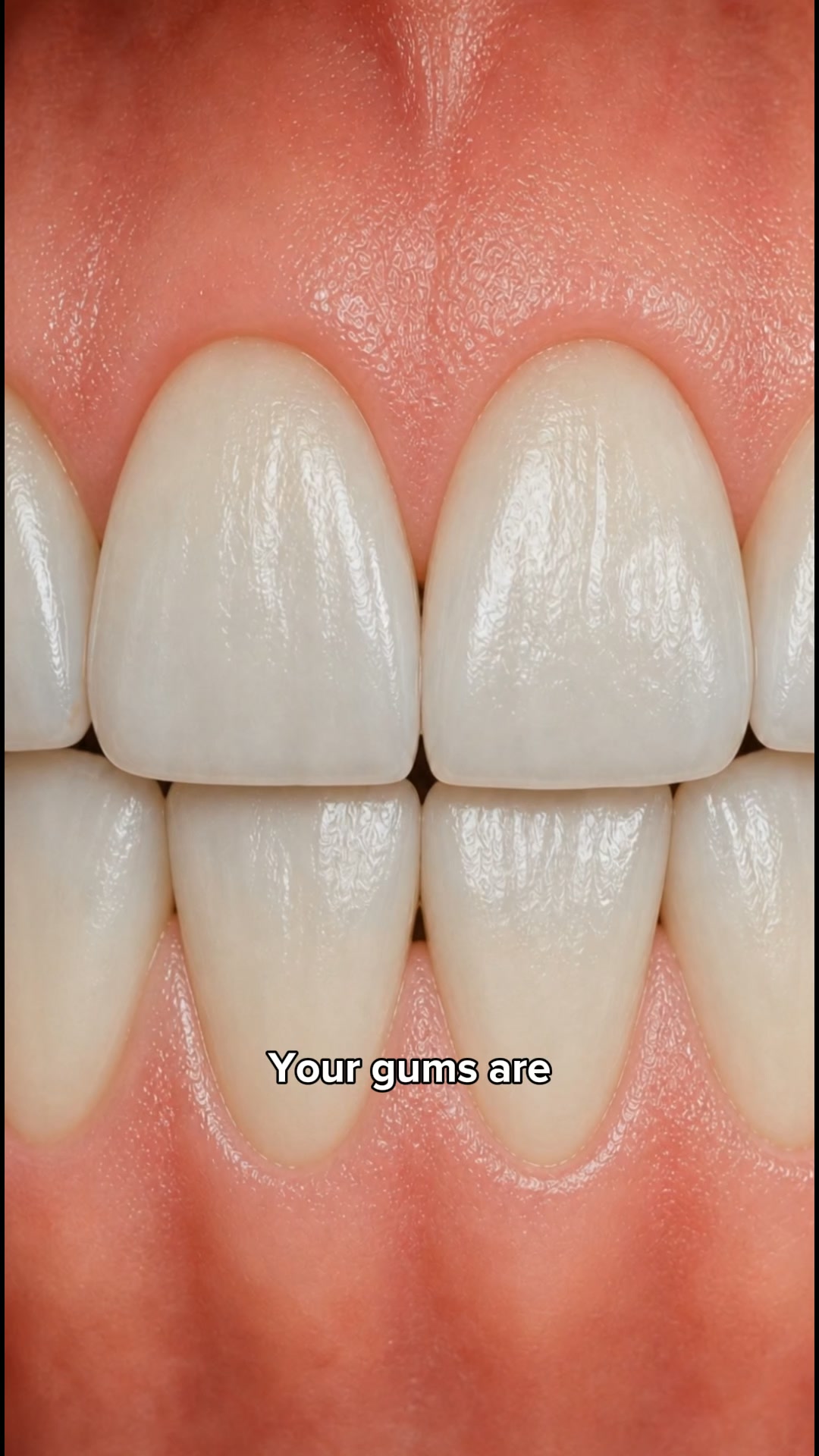 My Gums Kept Pulling Back