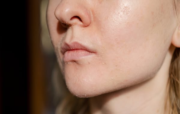 Why is Your Skin Dull?
