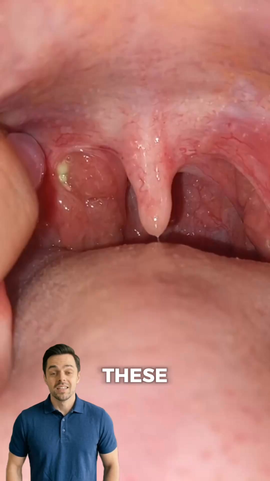 Day 1: I finally saw what was in my throat. Day 30: it's gone.
