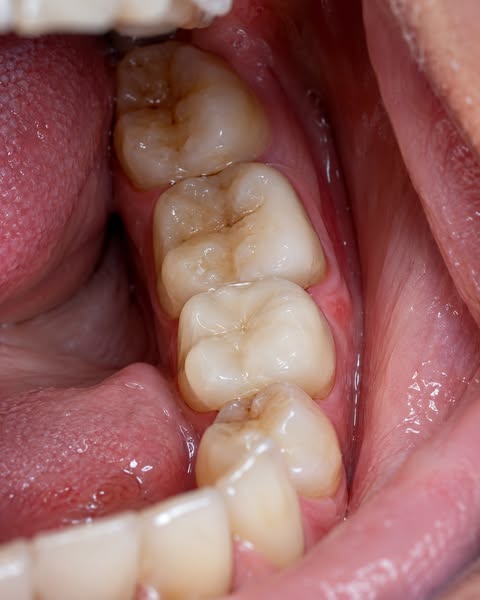 “I Finally Stopped Thinking About Food. Now I’m Thinking About Which Tooth Will Hurt.”