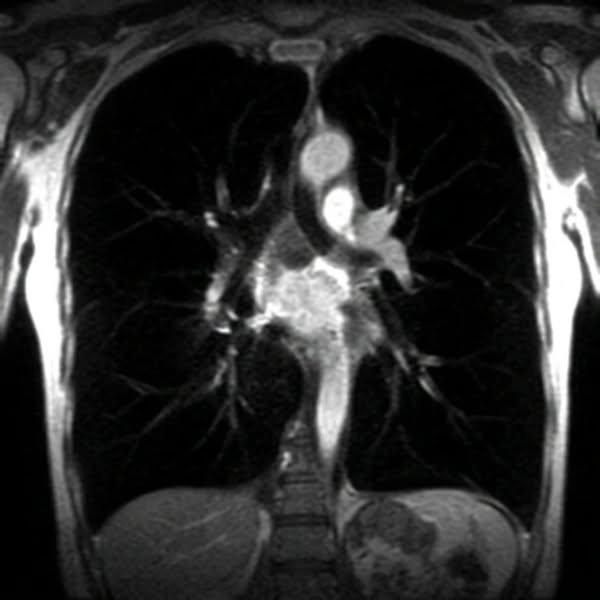 There Are Two Layers In Your Lungs