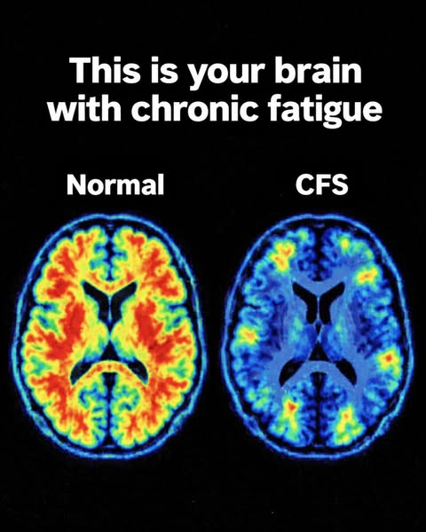 I Was Diagnosed With Chronic Fatigue (ME/CFS) At 34. I Have A Three-Year-Old And I Cannot Get Off The Floor Some Days.