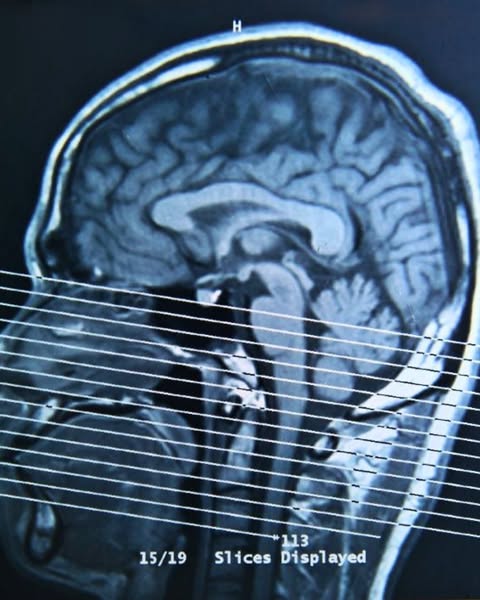 I Had A Concussion Nine Years Ago. My Neurologist Said 'You Should Be Better By Now.' Turns Out The Concussion Healed. Something Else Starte