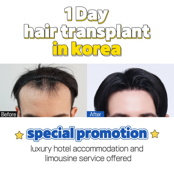 1 Day hair transplant in Korea