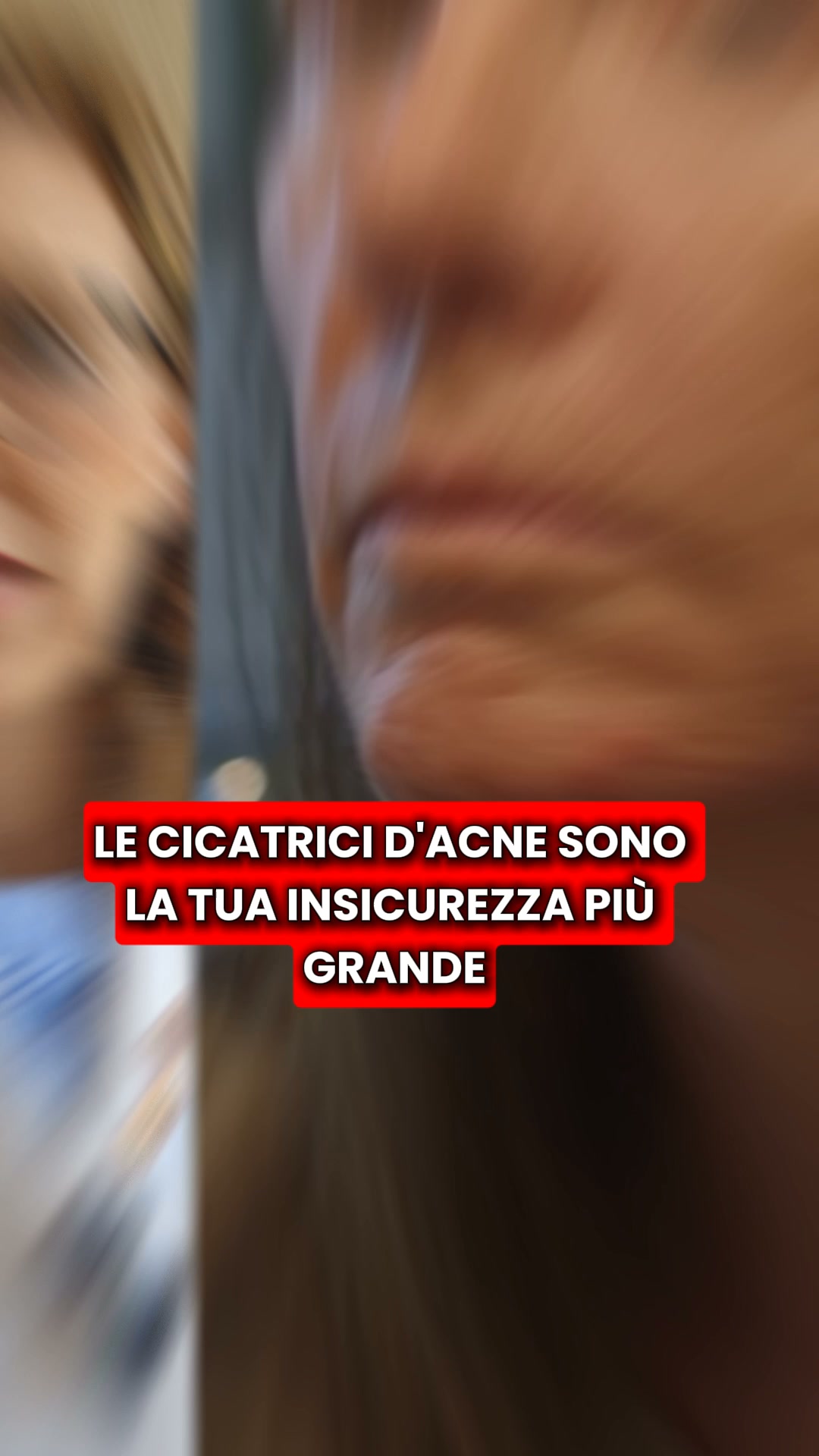 Scopri il kit micro-infusione Renovae
