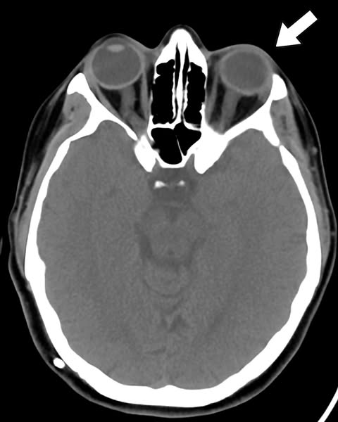 I Was Diagnosed With IIH At 32 After A Spinal Tap. I'm 40 Now. My Neuro-Ophthalmologist Never Asked Me About The Headaches I Had Before The