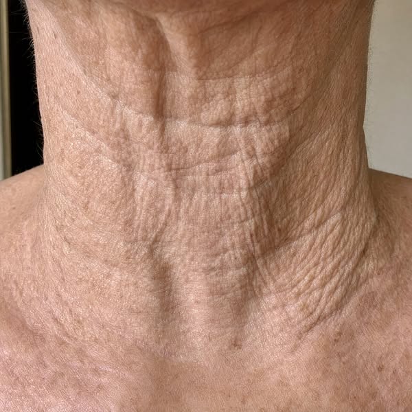 Noticing sagging under your jawline?