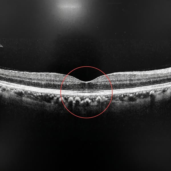 Een optometrist over de fout die 9 van de 10 oogpatiënten nog steeds maakt
