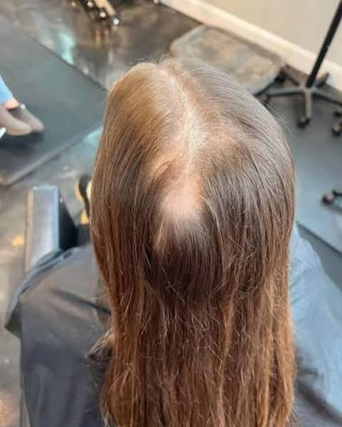I lost two and a half stone on Mounjaro. Then I lost half my hair.