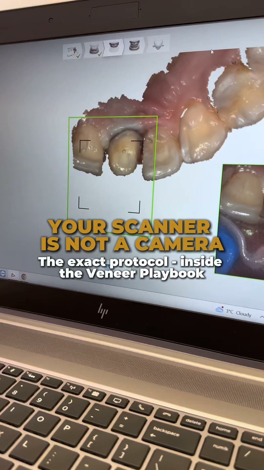 The Exact Veneer Workflow — $64