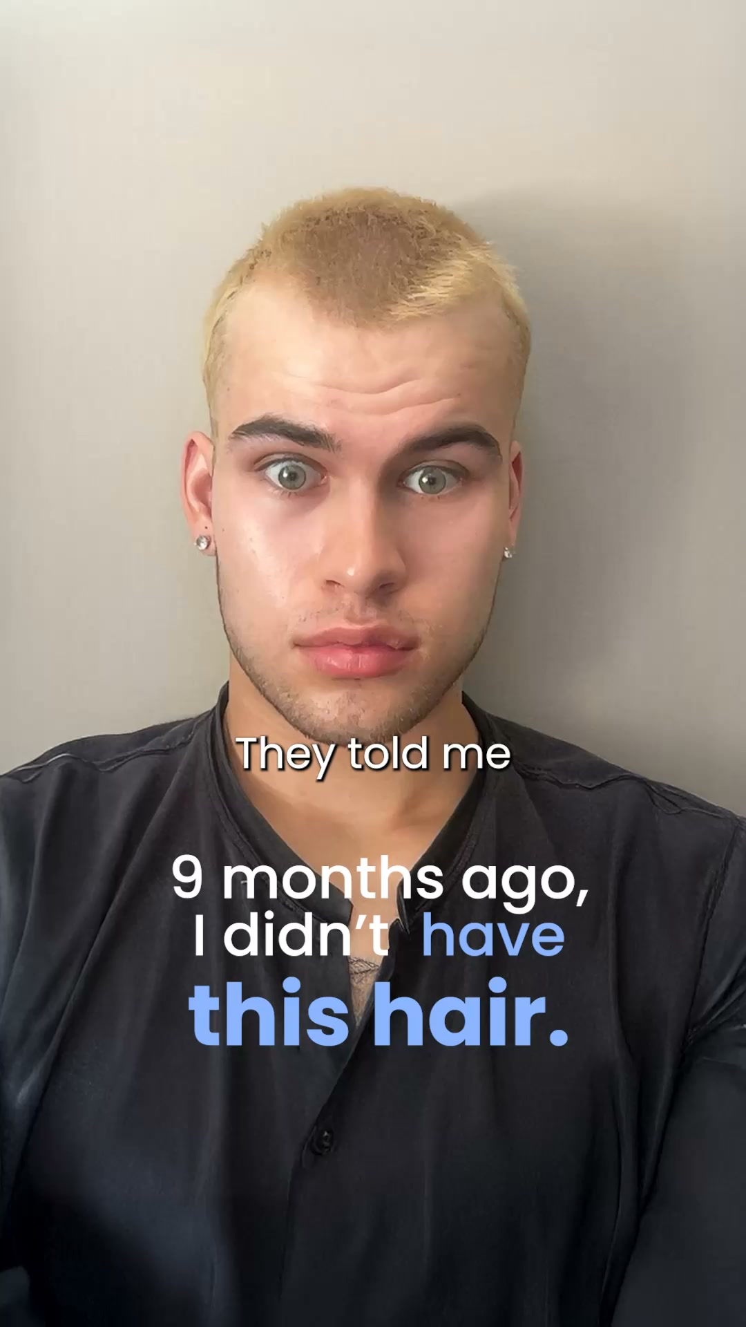 Hair Transplant in Turkey