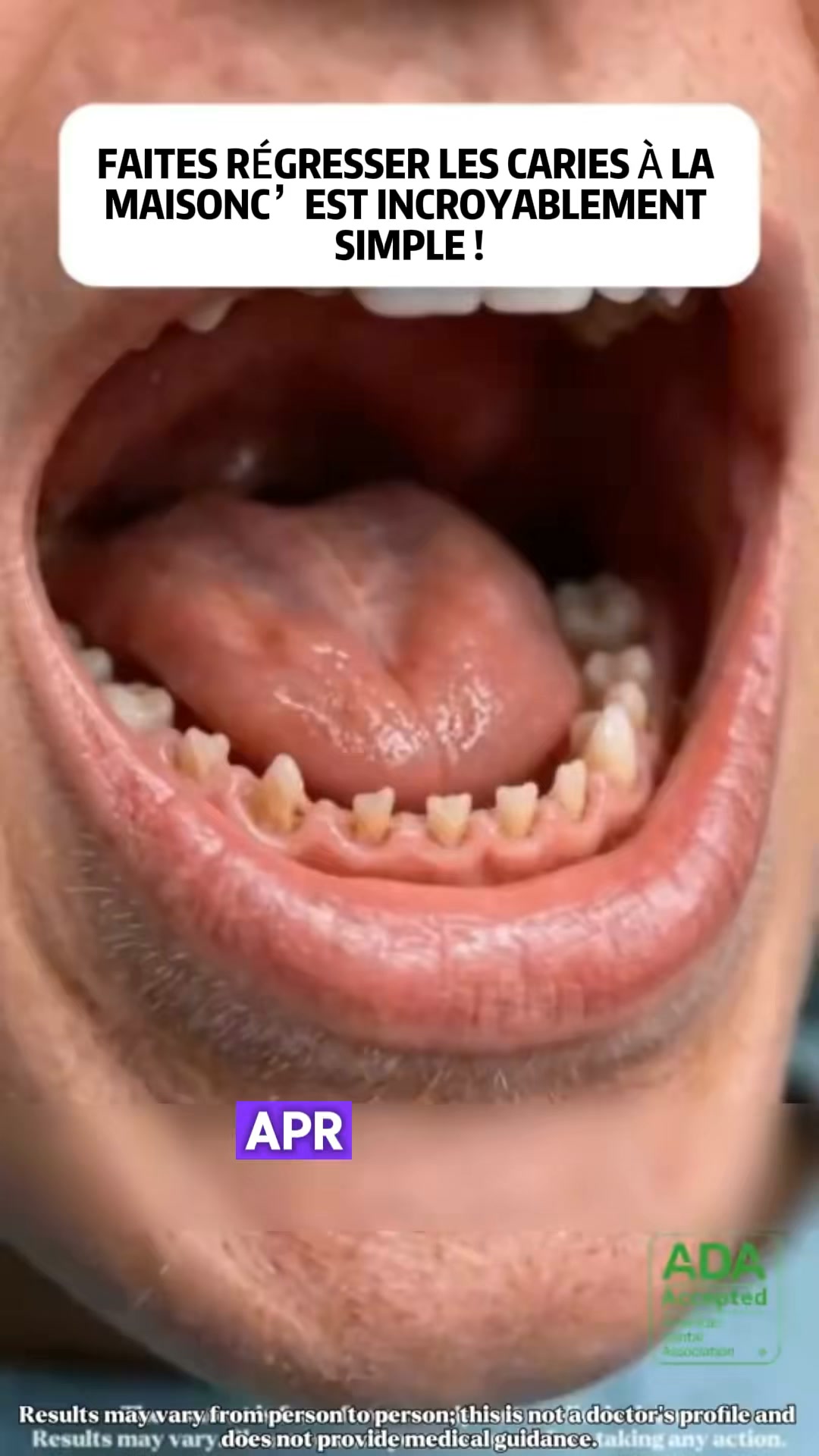 La manière plus sûre d’avoir des dents plus fortes