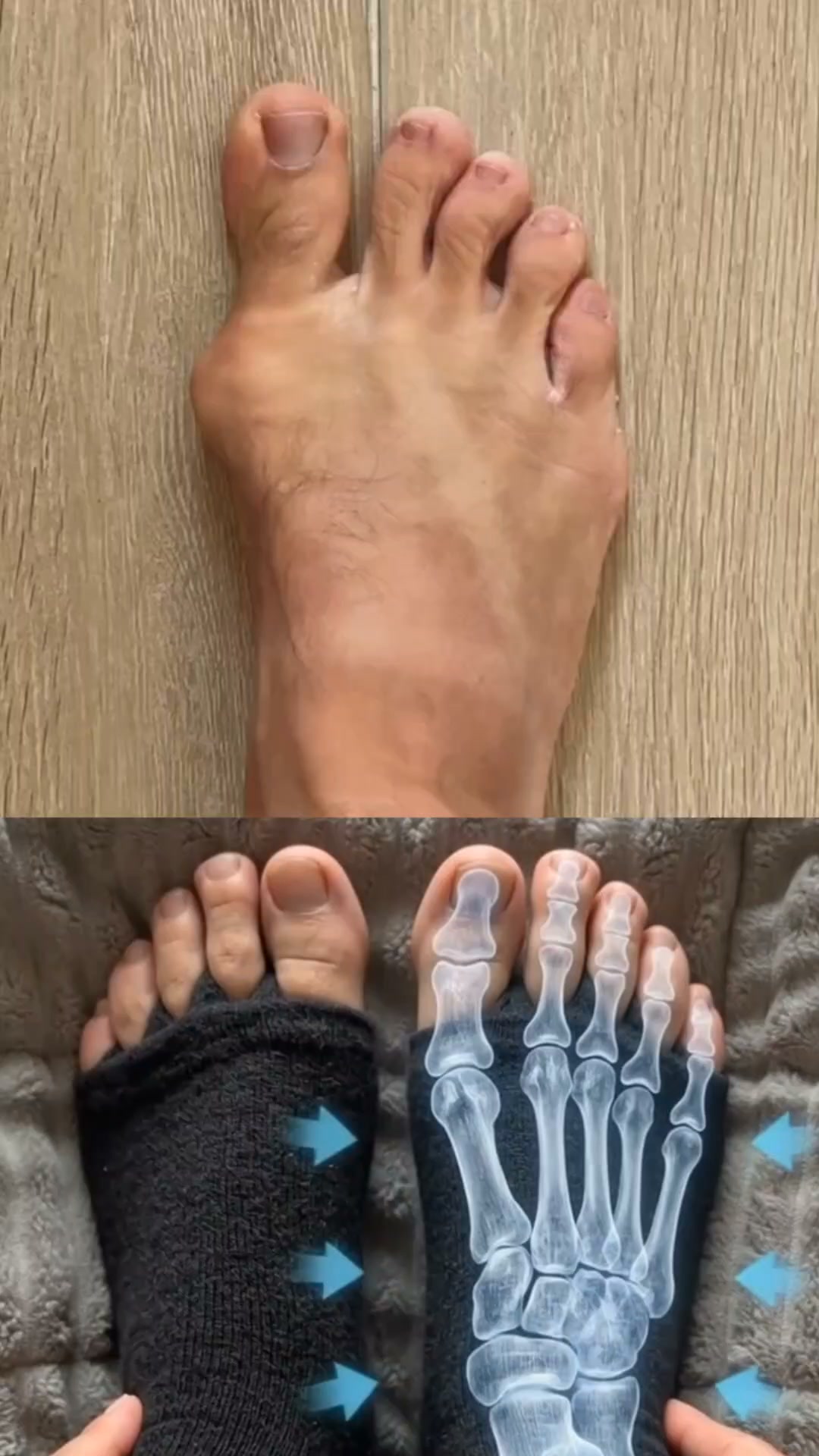 Fix Bunion Pain Today