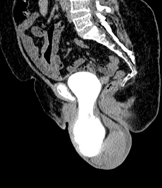 Considering surgery for your prolapse?
