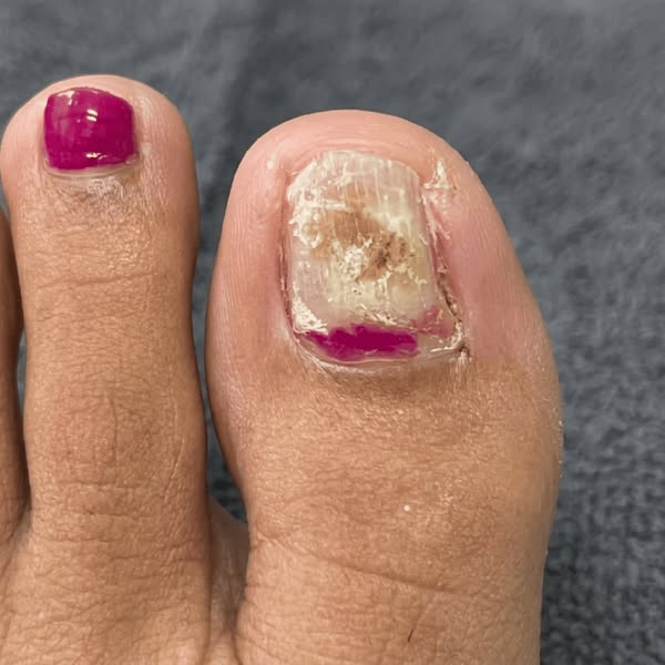 A mycologist told me why nothing works for toenail fungus