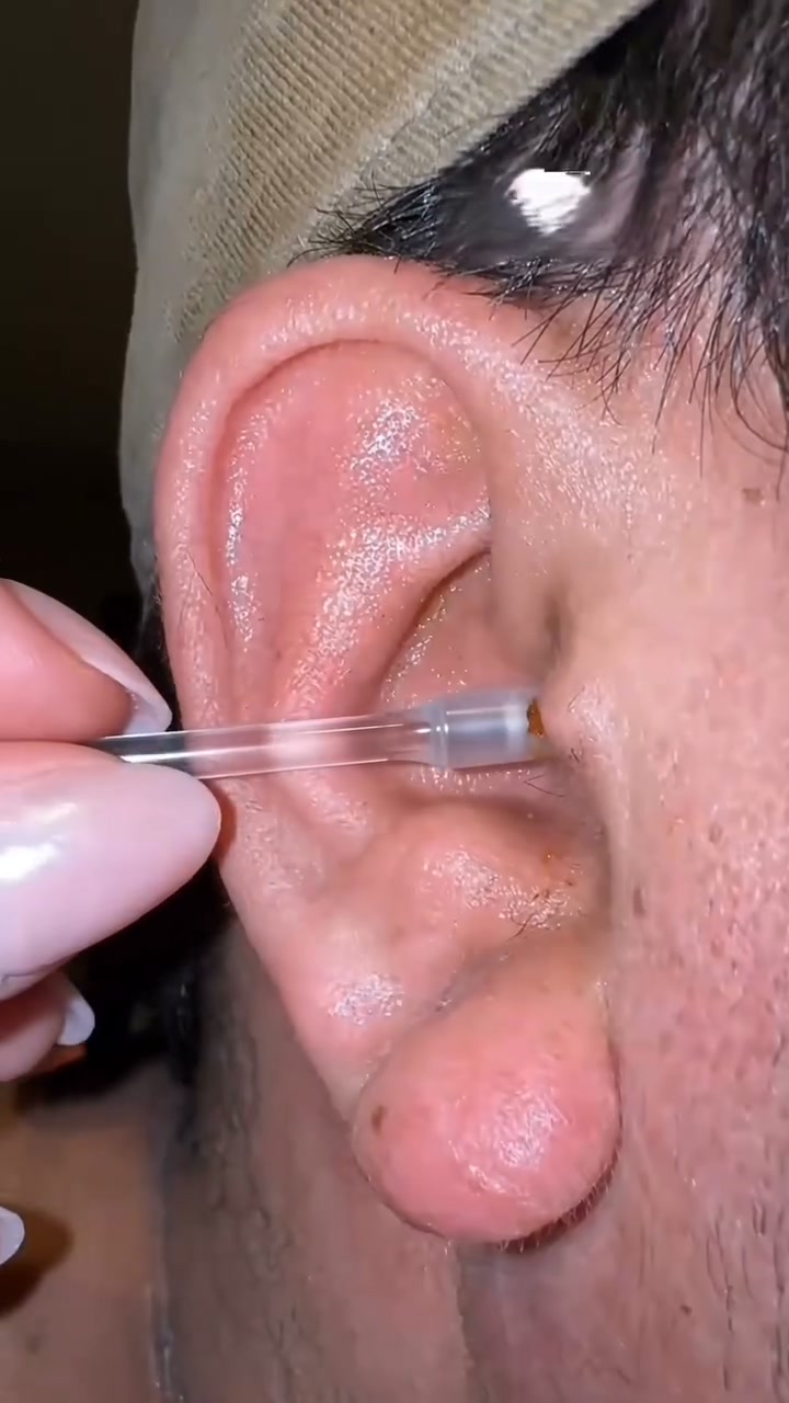 Cotton Swabs Were Never Meant For Your Ears!
