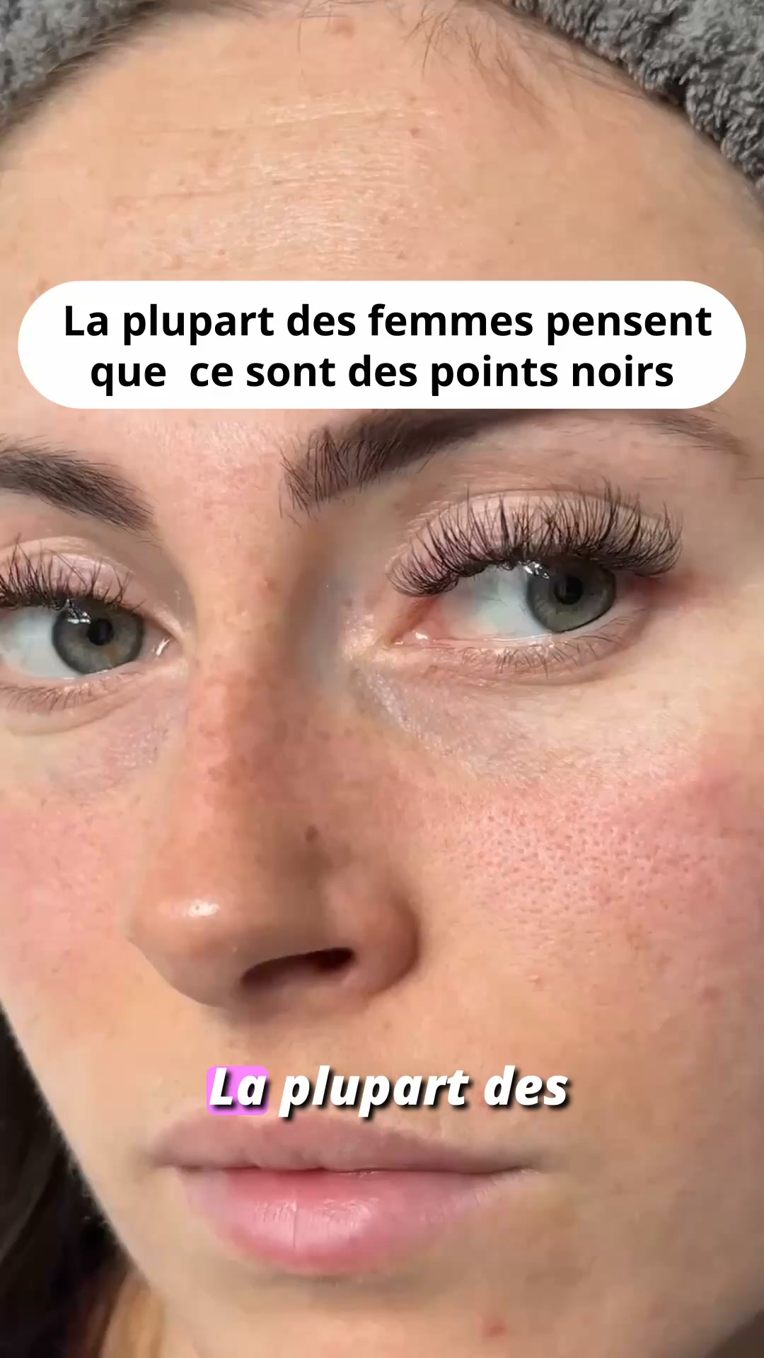 Points noirs : arrête de mal les traiter