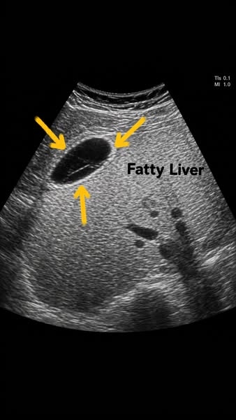 Fatty liver killed my brother. I reversed mine in 8 weeks.