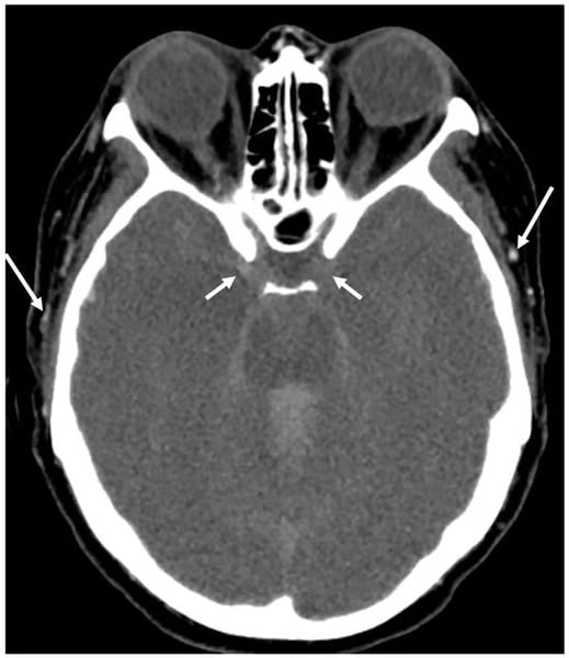 Computed Tomography Angiography as Ancillary Testing for Death Determination by Neurologic Criteria: A Technical Review