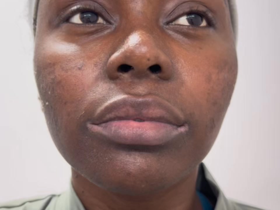 Brighten Dark Lip Pigmentation