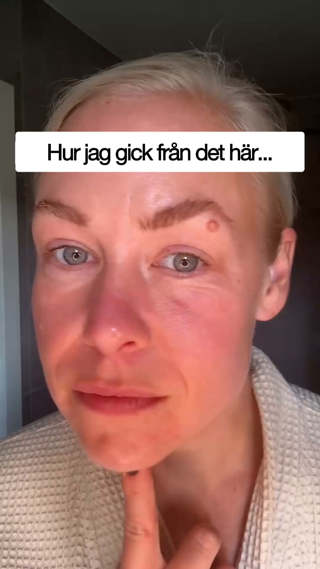 Slätare linjer utan botox