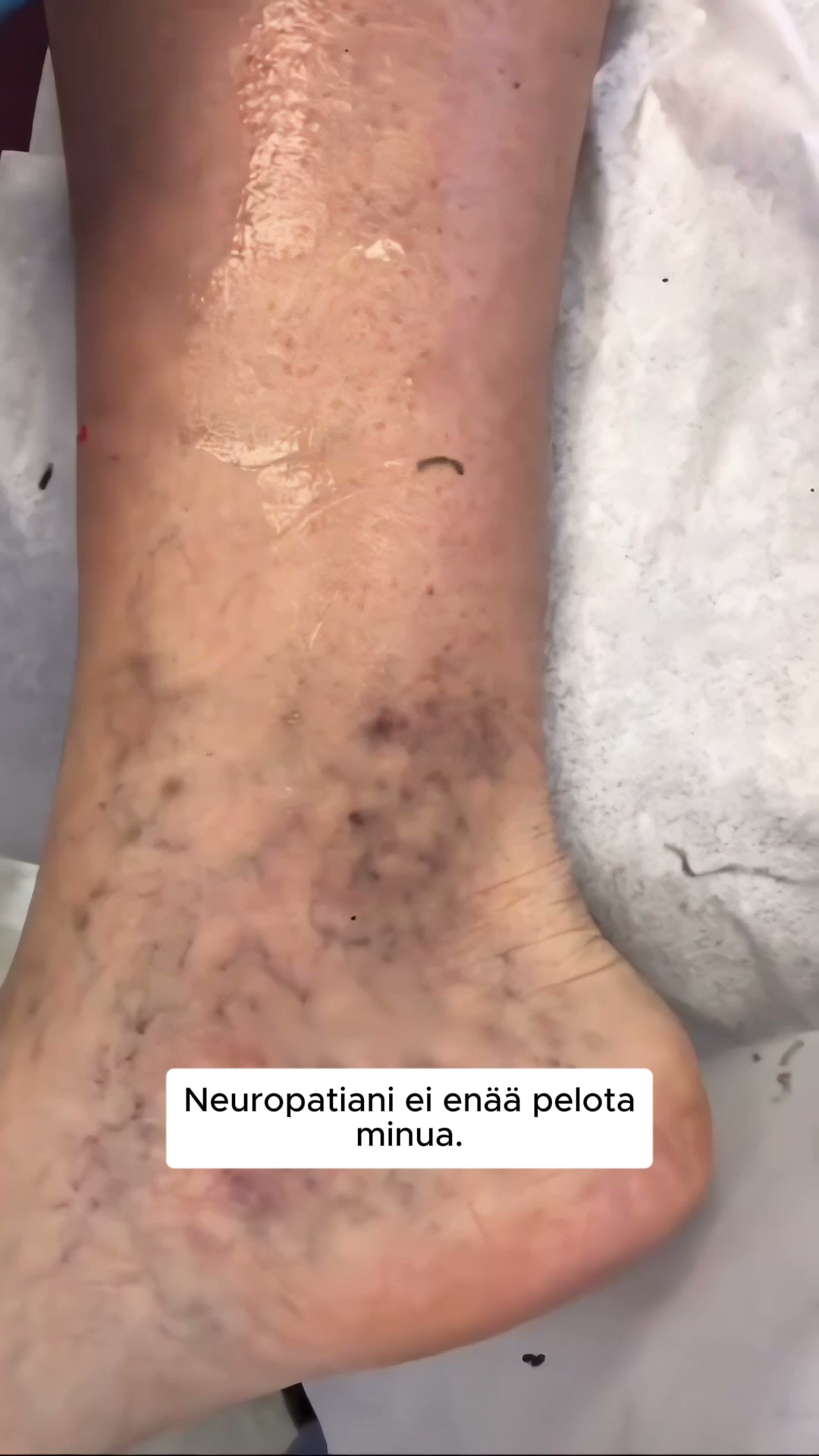 Helpotusta poltteleville, pisteleville ja puutuneille jaloille 4.8/5