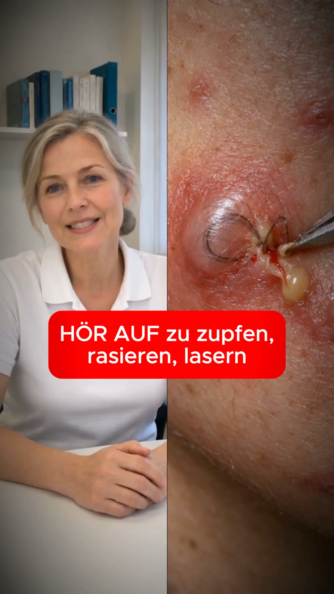 Damenbart? Hör auf zu rasieren, zupfen oder Lasern!