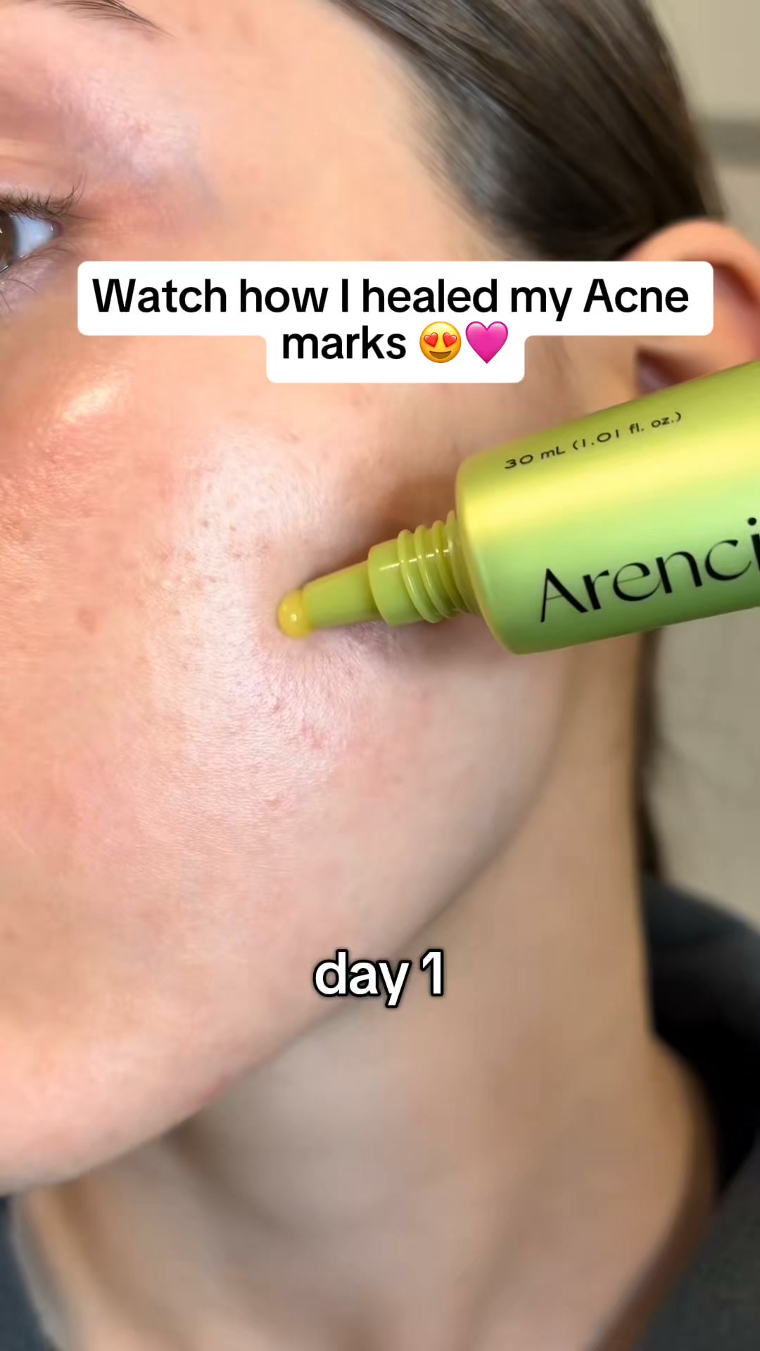 Antioxidant Care for Dark Spots + Post-Acne Marks