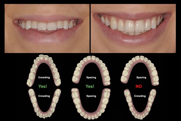 The Aligner Selection System