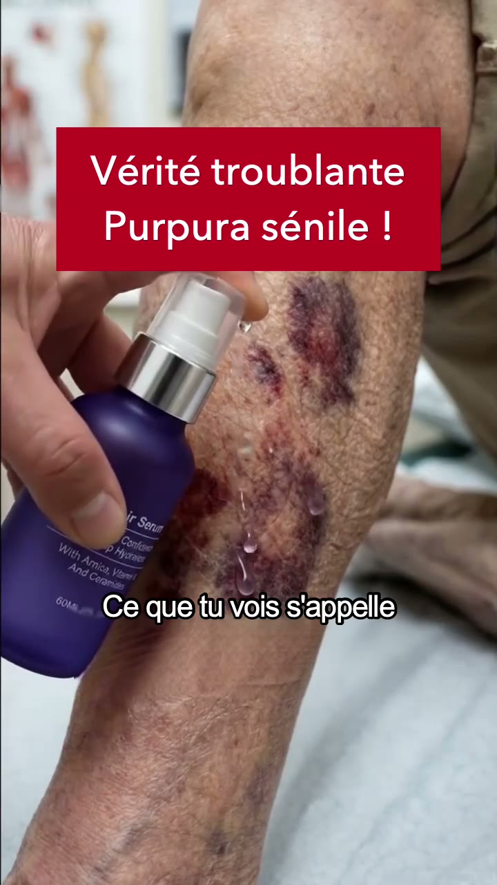 Ta peau marque au moindre choc ?