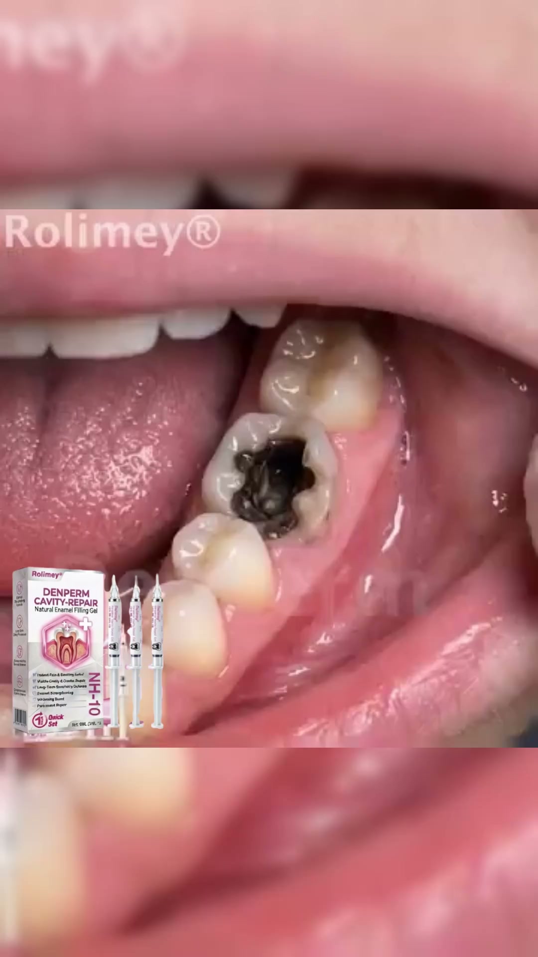 Cavity Repair FDA-Recognized 10% Nano-Hydroxyapatite (NH-10) | Delivery within 2-4 working days | Full refund guarantee
