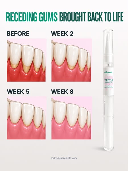 My Gums Kept Pulling Back