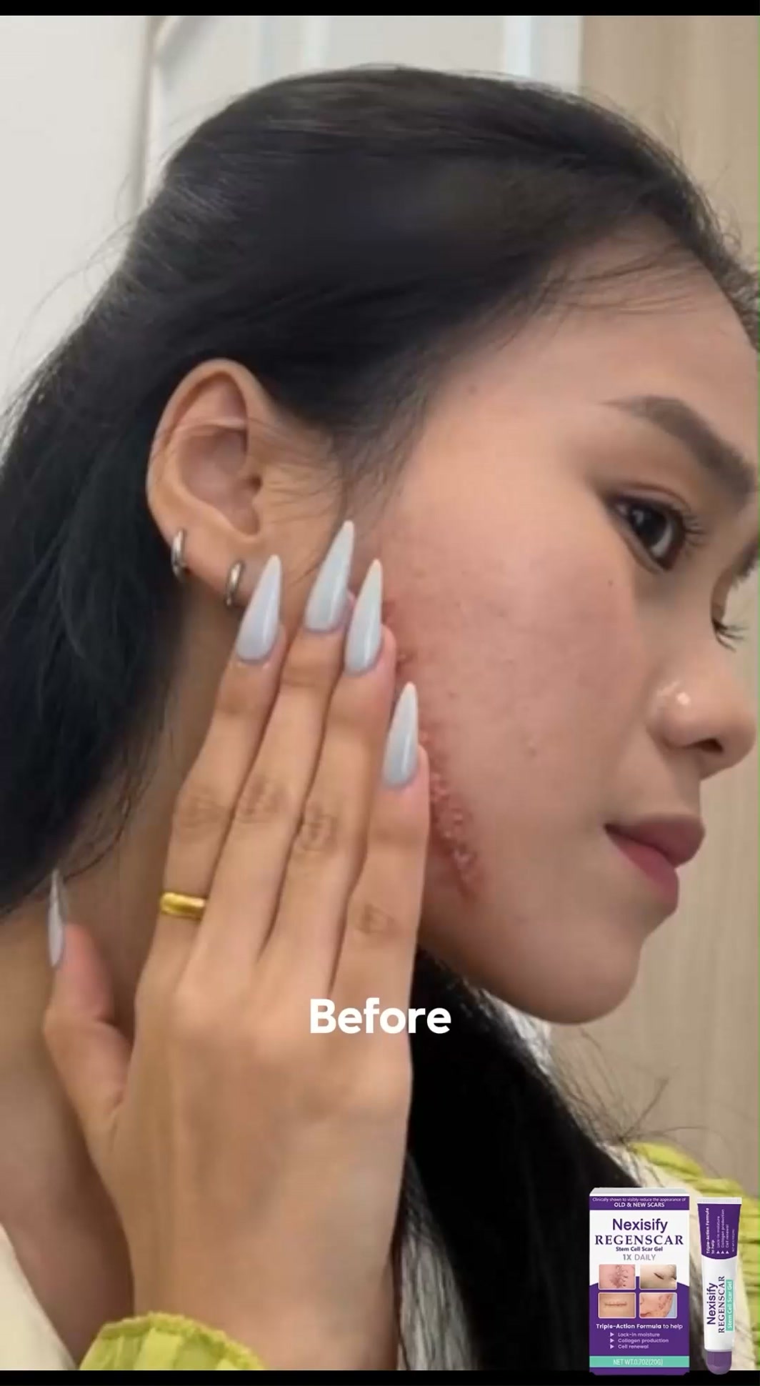 Say Goodbye to Stubborn Old & New Scars