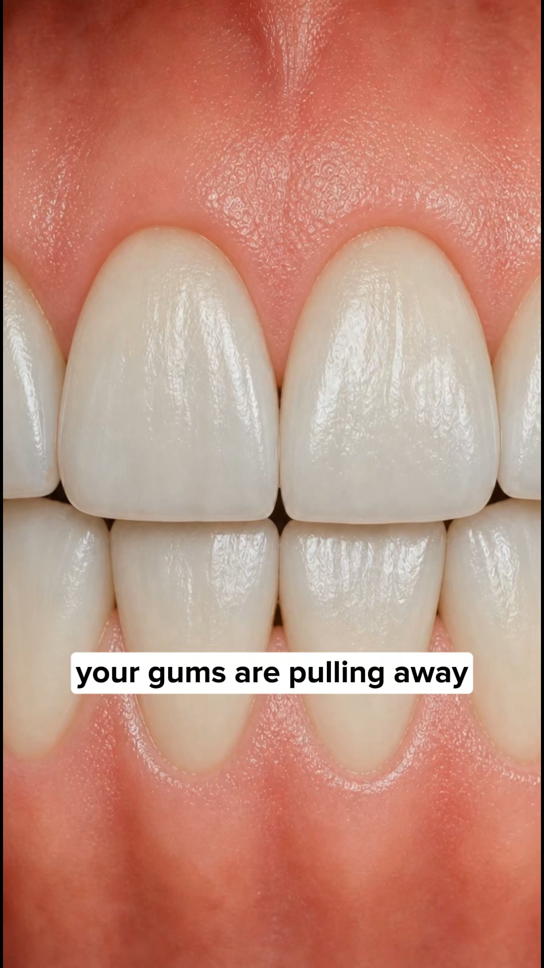 My Gums Kept Pulling Back