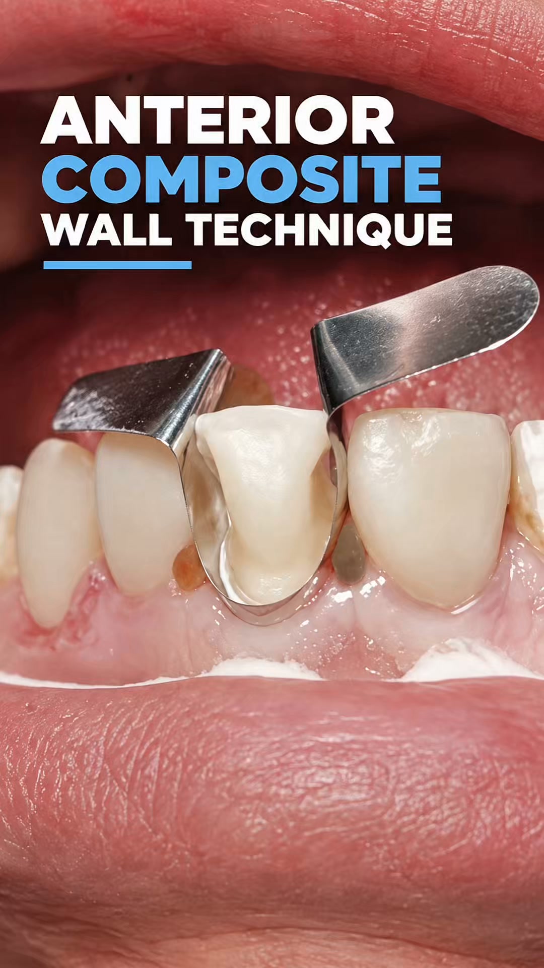 Anterior Sectional Matrices, Done Right