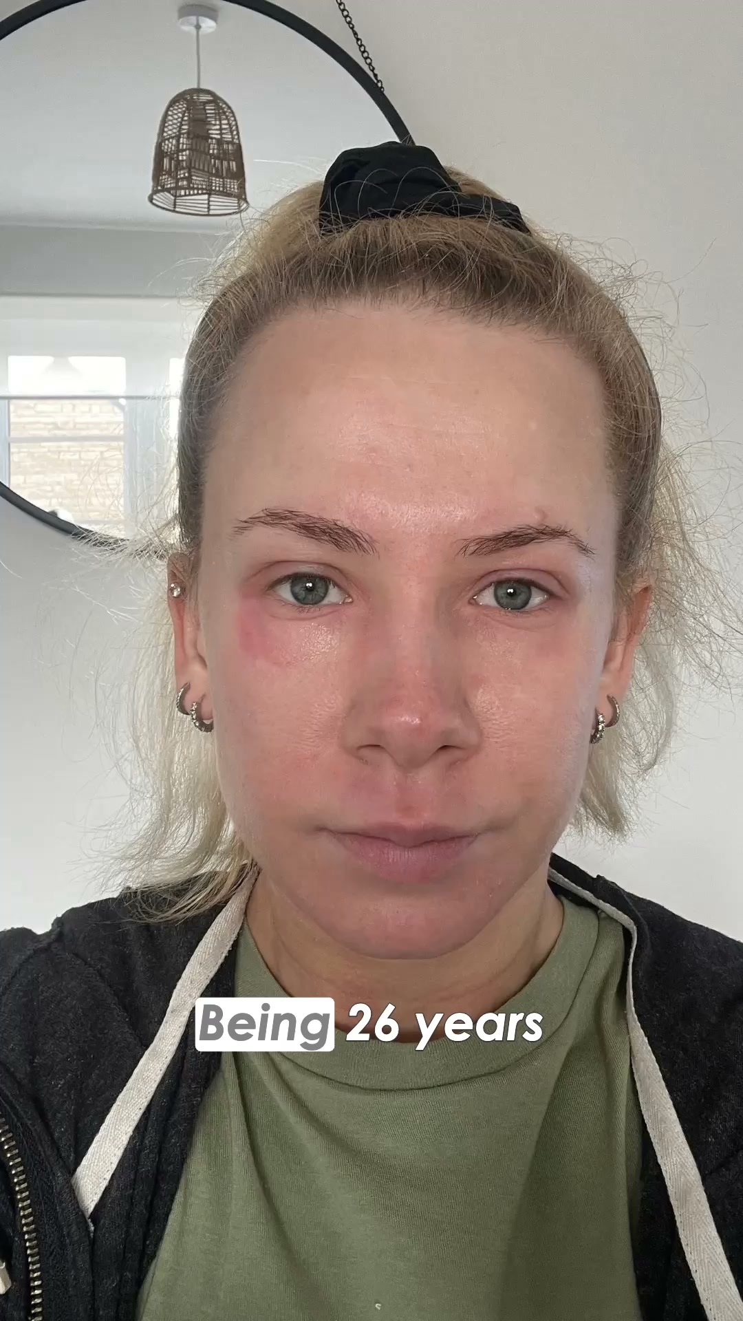 What's Causing Your Eyelid Eczema?