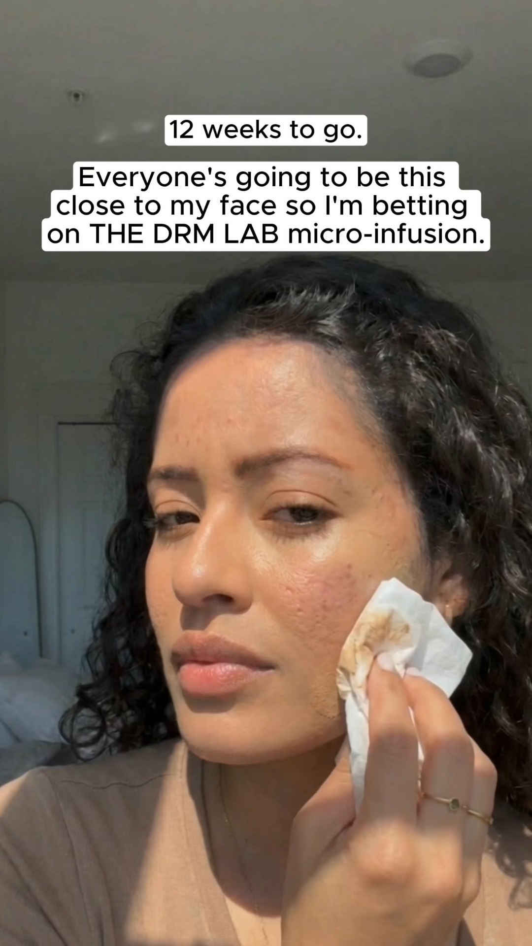 My 12-Week Acne Scar Countdown