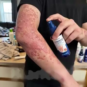 Tired of Itching, Flaking & Greasy Creams?