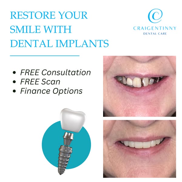 Restore Your Smile with Dental Implants