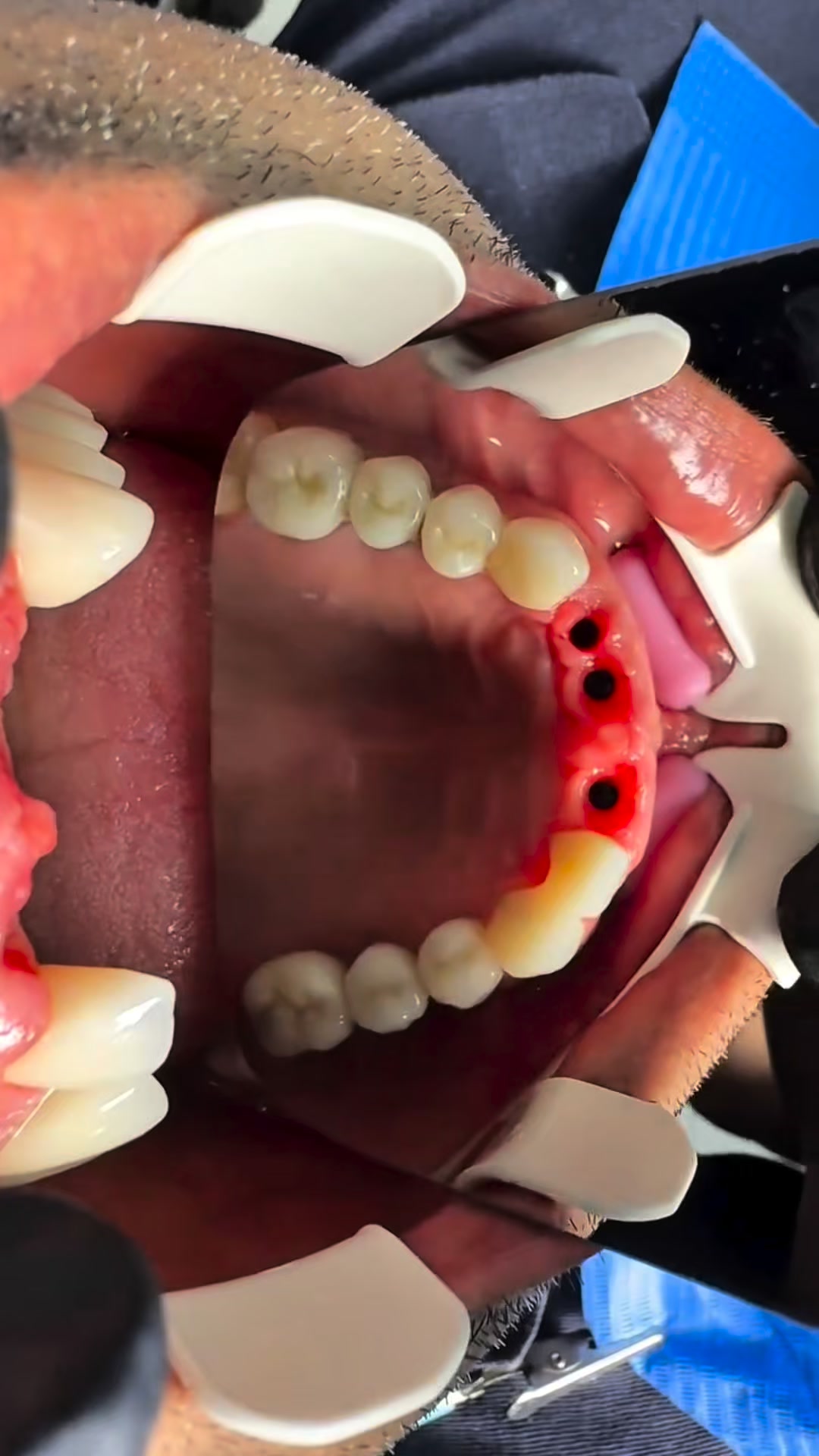 ALL implant brands in 1 compact Kit