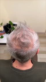 Seeing More Scalp Lately?