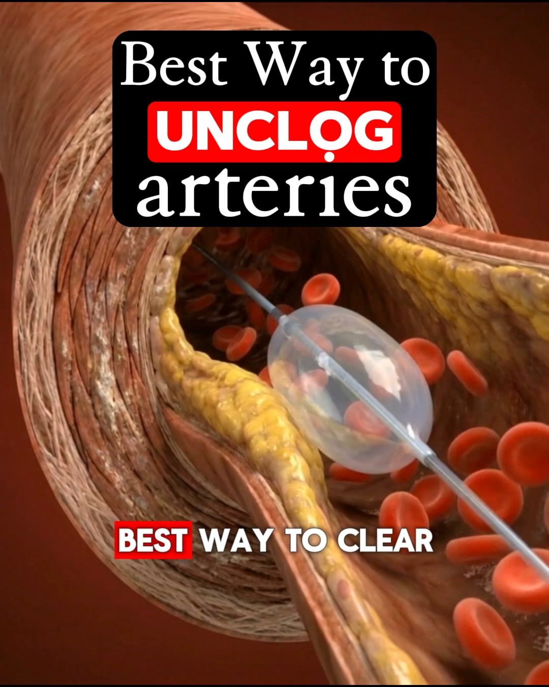 Got Artery Plaque? What Are You Waiting For?