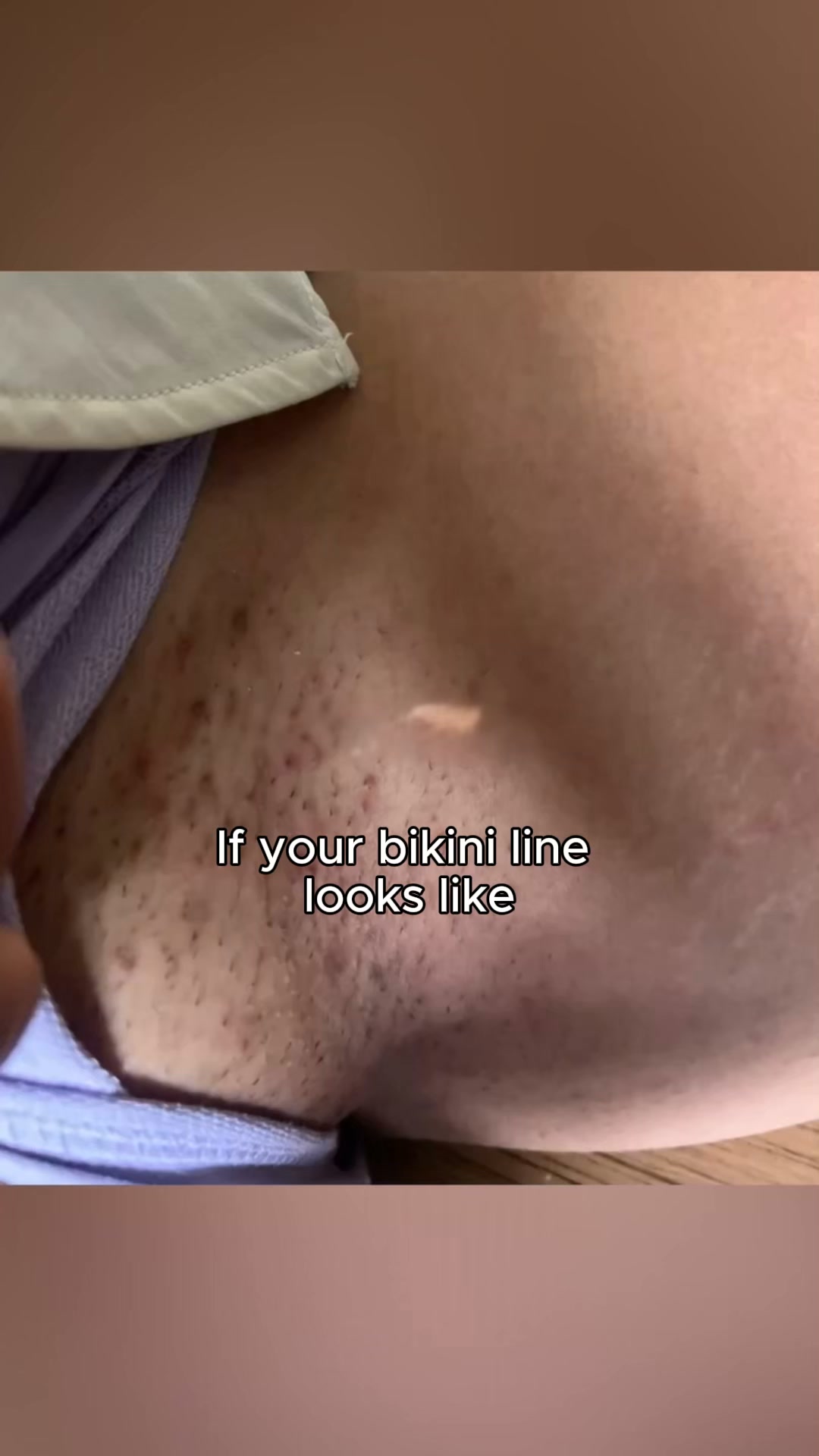 #1 Top-Rated Solution for Problem Areas Around the Bikini Line