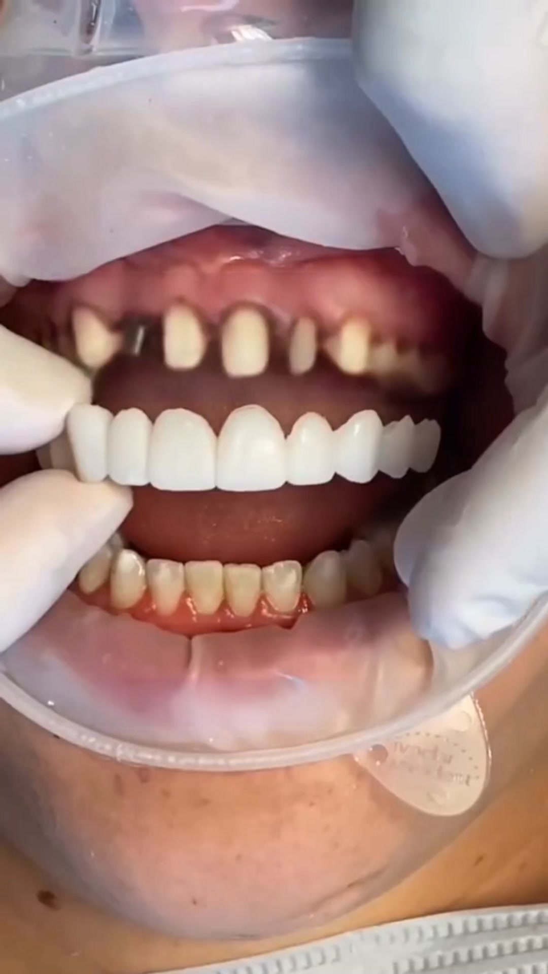 Le sourire parfait, sans dentiste