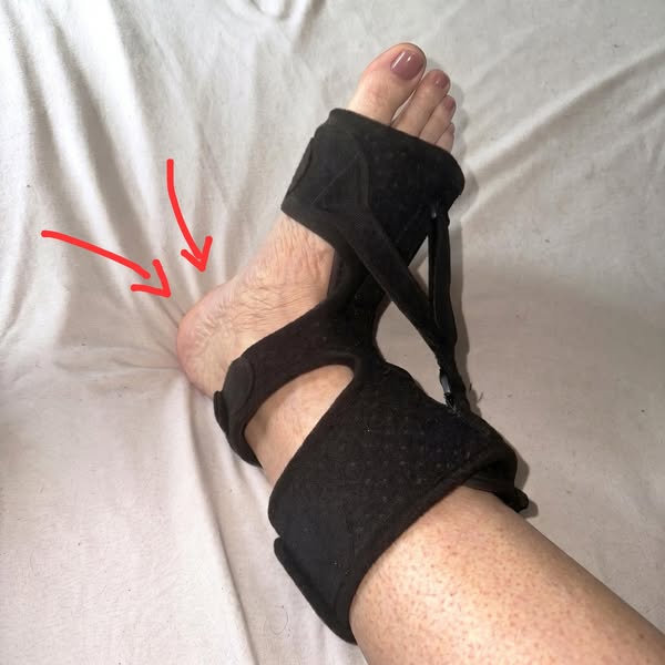 Plantarfasziitis bestimmte mein Leben, bis ich die Ursache fand...