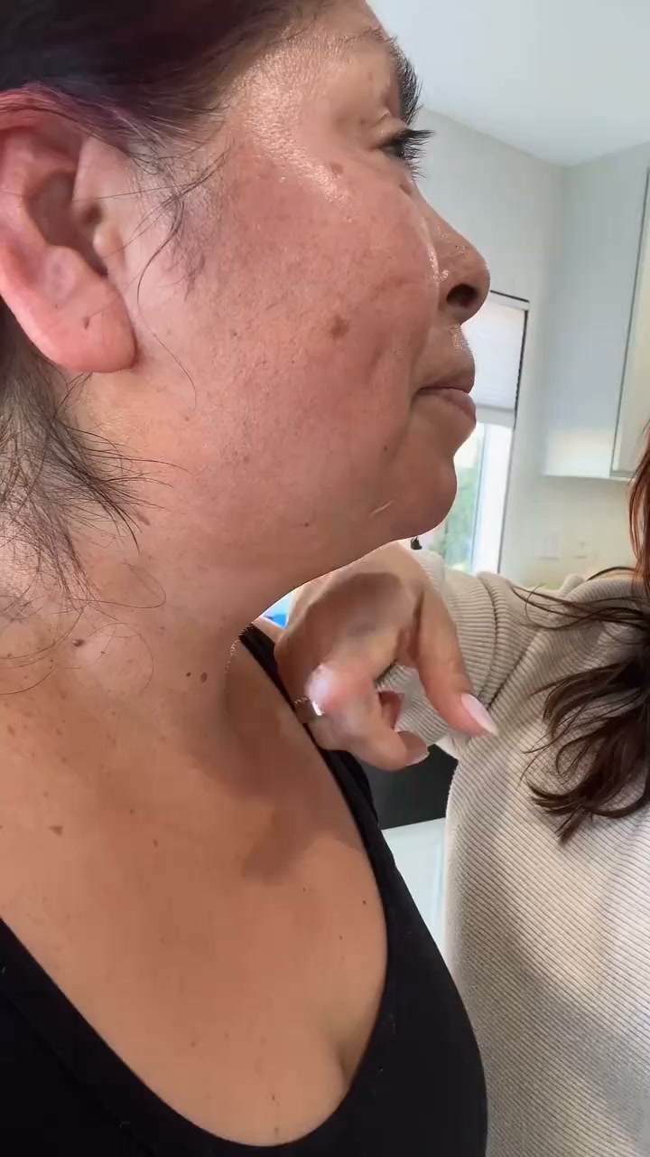 Loose Skin & a Soft Double Chin Ruining Your Side Profile? Refresh Your V-Line in 30 Minutes