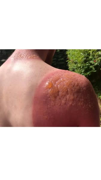La vérité sur le "bronzage classique"