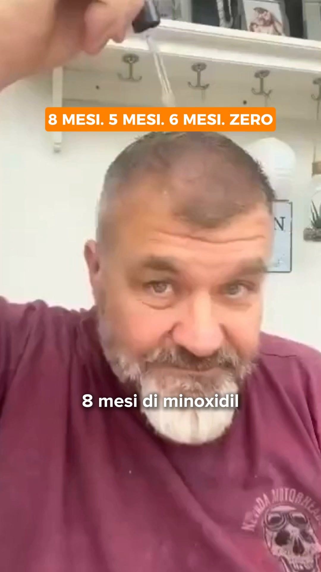 La verità che non ti dicono sul trapianto dei capelli